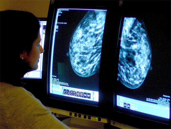 Scots team pioneer AI breast cancer screening