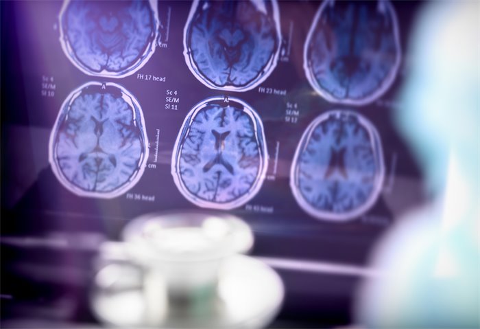 Scientists develop method to track Alzheimer’s disease in real time