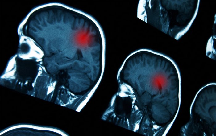Stroke care target missed for eighth year in row