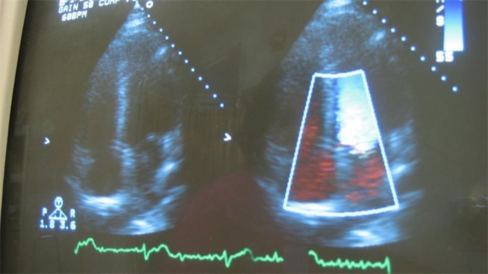 Heart failure in Scotland remains a challenge