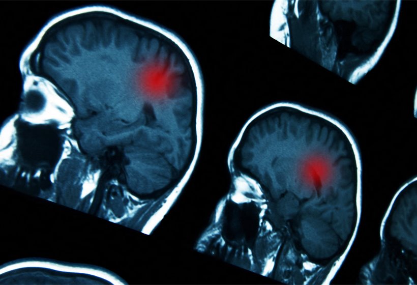 Stroke care target missed for eighth year in row