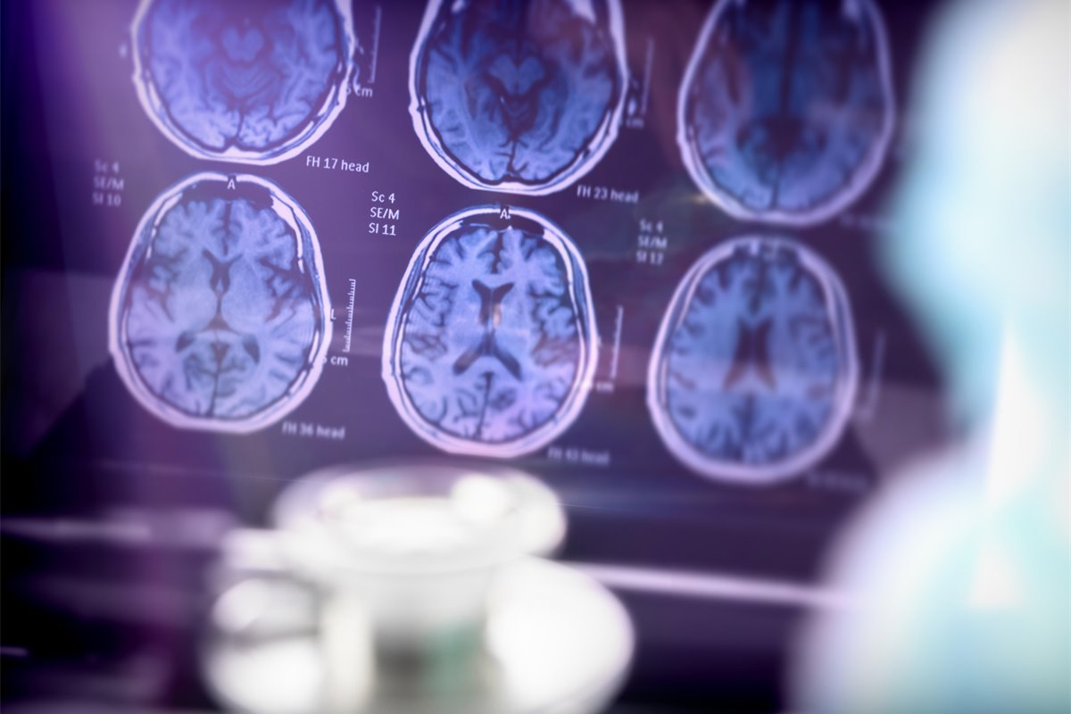 Scientists develop method to track Alzheimer?s disease in real time