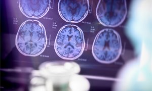 Scientists develop method to track Alzheimer’s disease in real time